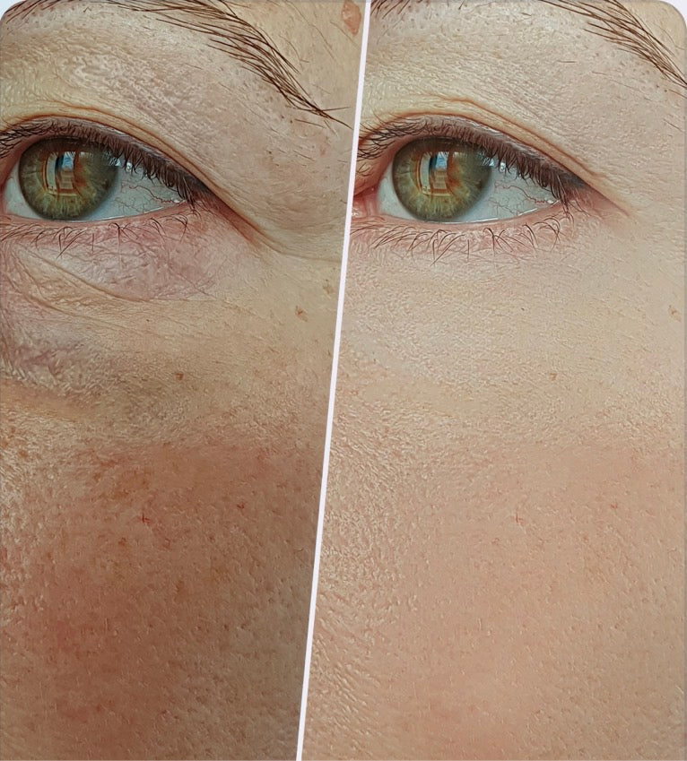 DermaLume’s Anniversary sale