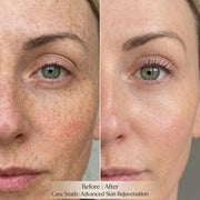 DermaLume Red Light Therapy Mask